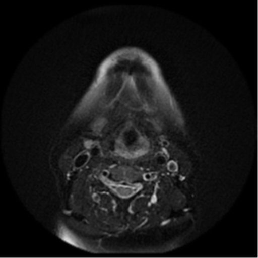 File:Adenoid cystic tumor of palate (Radiopaedia 46980-51519 Axial T2 8).png