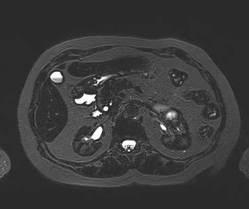 File:Adenomyomatosis of the gallbladder (Radiopaedia 50246-55587 Axial 36).png