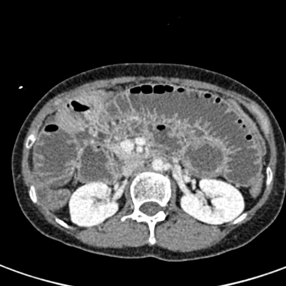 Adhesional small bowel obstruction (Radiopaedia 48397-53305 Axial C+ portal venous phase 28).jpg