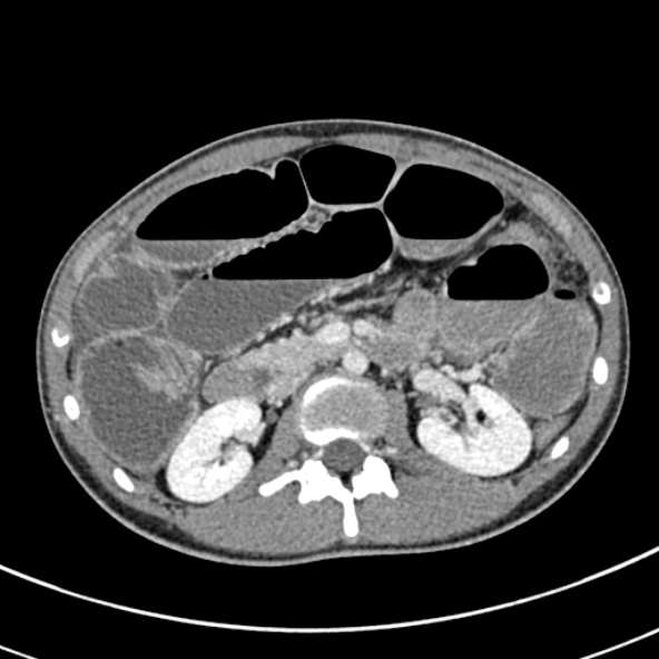 Adhesional small bowel obstruction (Radiopaedia 52107-57980 Axial C+ portal venous phase 46).jpg