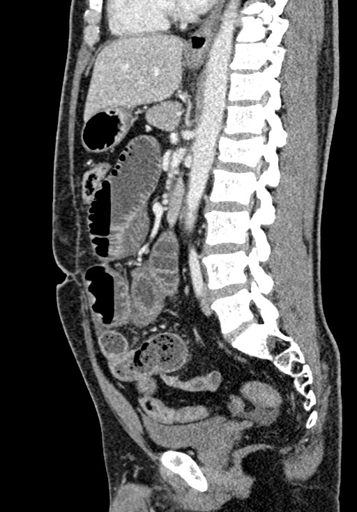 Adhesional small bowel obstruction (Radiopaedia 58900-66131 Sagittal C+ portal venous phase 136).jpg