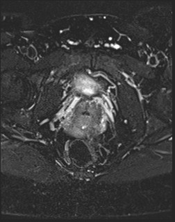 File:Adnexal multilocular cyst (O-RADS US 3- O-RADS MRI 3) (Radiopaedia 87426-103754 Axial T2 fat sat 20).jpg