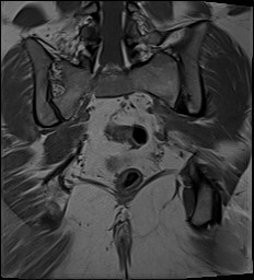 File:Adnexal multilocular cyst (O-RADS US 3- O-RADS MRI 3) (Radiopaedia 87426-103754 Coronal 25).jpg