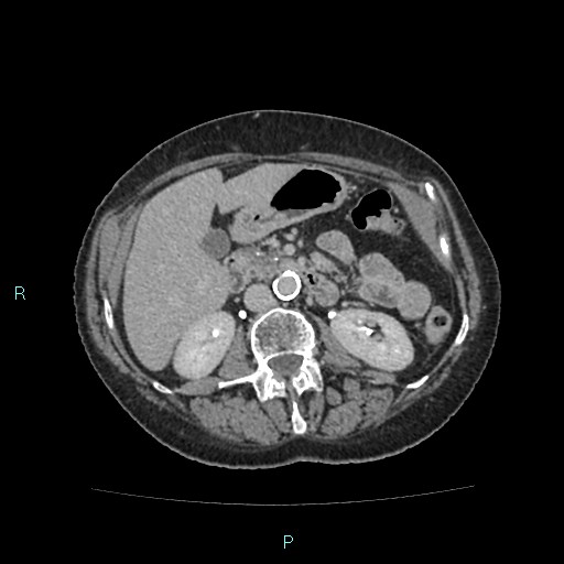 File:Adrenal collision tumor (ACT) (Radiopaedia 48462-53379 Axial C+ delayed 28).jpg