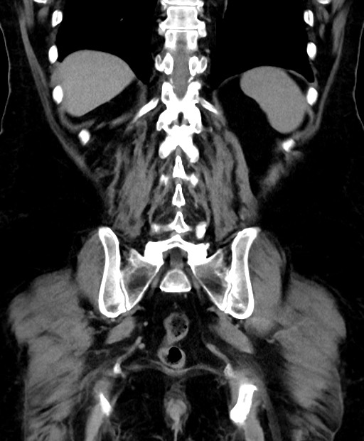 Adrenal cortical carcinoma (Radiopaedia 64017-72769 Coronal C+ delayed 48).jpg