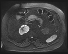 Adrenal cortical carcinoma (Radiopaedia 64017-72770 Axial DWI 102).jpg