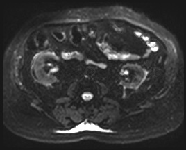 Adrenal cortical carcinoma (Radiopaedia 64017-72770 Axial DWI 31).jpg