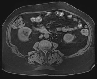 Adrenal cortical carcinoma (Radiopaedia 64017-72770 Axial T1 fat sat 56).jpg