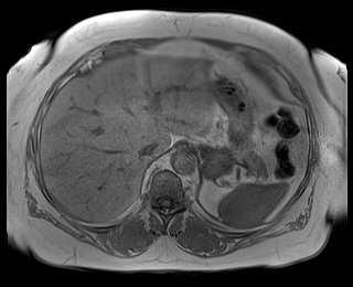 File:Adrenal cortical carcinoma (Radiopaedia 64017-72770 Axial T1 in-phase 13).jpg