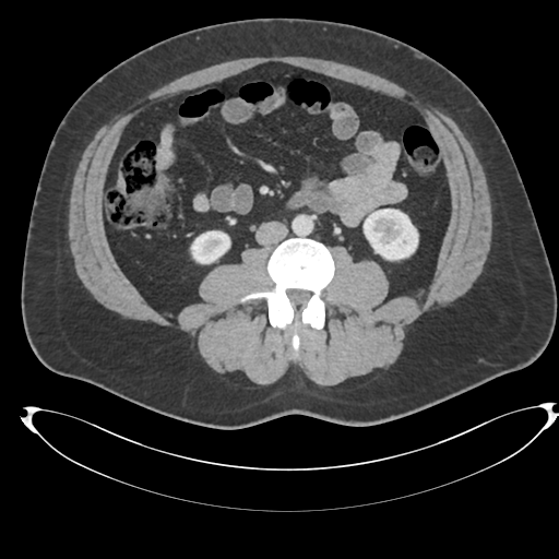 File:Adrenal cyst (Radiopaedia 45625-49778 AXIAL THICK 60 sec 57).png