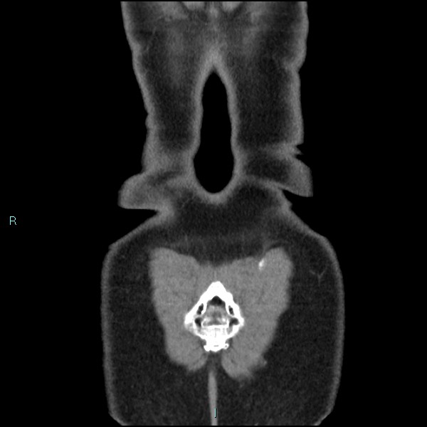 Adrenal cystic lymphangioma (Radiopaedia 83161-97534 Coronal C+ portal venous phase 76).jpg