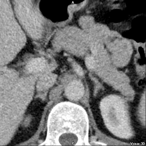 File:Adrenal glands (normal CT anatomy) (Radiopaedia 16570-105725 Axial 4).jpg