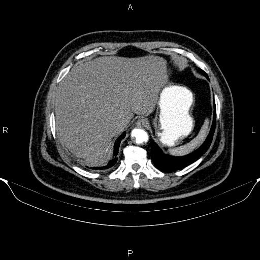 Adrenal hemorrhage (Radiopaedia 62622-70916 Axial C+ arterial phase 48).jpg