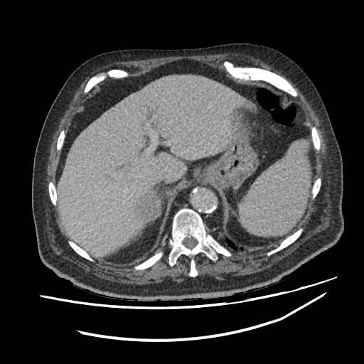 Adrenal lymphoma (Radiopaedia 84145-99415 Axial C+ portal venous phase 13).jpg