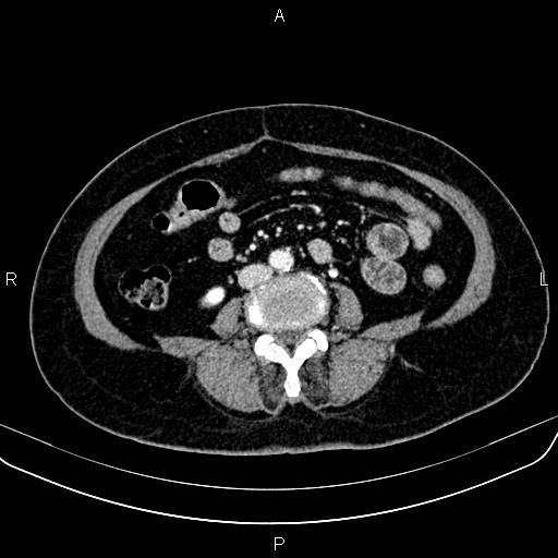 Adrenal myelolipoma (Radiopaedia 82742-96986 Axial renal cortical phase 104).jpg