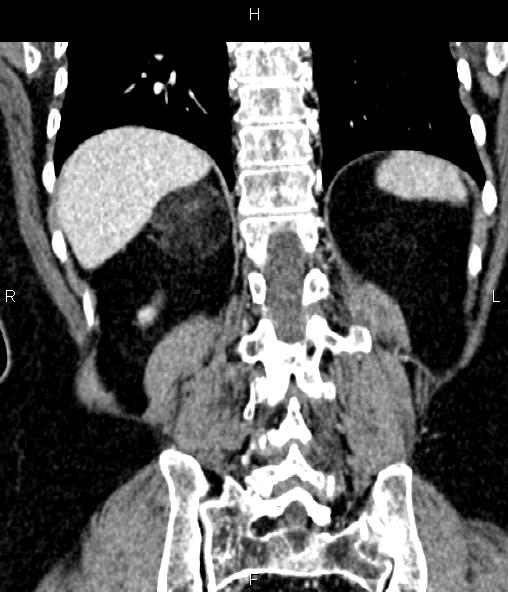 File:Adrenal myelolipoma (Radiopaedia 82742-96986 Coronal renal cortical phase 59).jpg