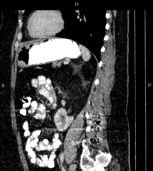 Adrenal myelolipoma (Radiopaedia 84319-99617 Sagittal renal cortical phase 64).jpg
