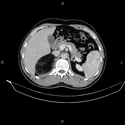 Adrenal myelolipoma (Radiopaedia 87794-104246 Axial renal cortical phase 32).jpg