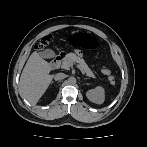 Adrenal myelolipoma and beaver tail liver (Radiopaedia 86201-102193 Axial non-contrast 162).jpg