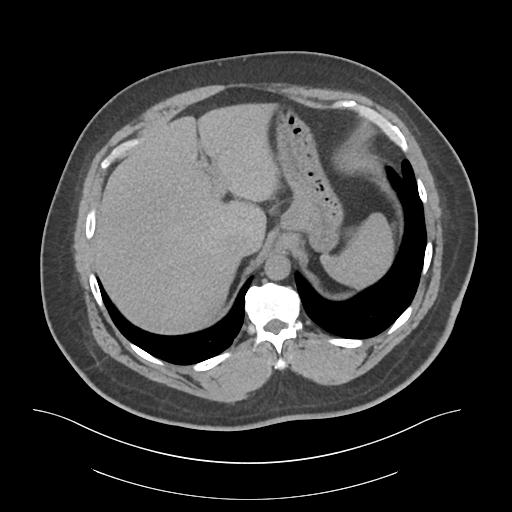 File:Adrenal vein sampling and adrenal nodular hyperplasia - Conn syndrome (Radiopaedia 30561-31337 Axial non-contrast 11).jpg