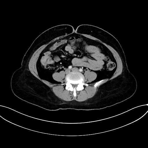 Adrenocortical carcinoma (Radiopaedia 87281-103569 Axial C+ portal venous phase 56).jpg
