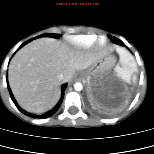 File:Adrenocortical carcinoma (Radiopaedia 9449-10131 Axial C+ portal venous phase 7).jpg