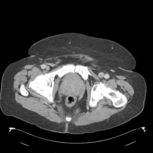 Adult ileal intussusception with secondary obstruction (Radiopaedia 30395-31051 Axial C+ portal venous phase 76).jpg