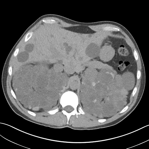 Adult polycystic kidney disease (Radiopaedia 47866-52626 Axial non-contrast 19).png