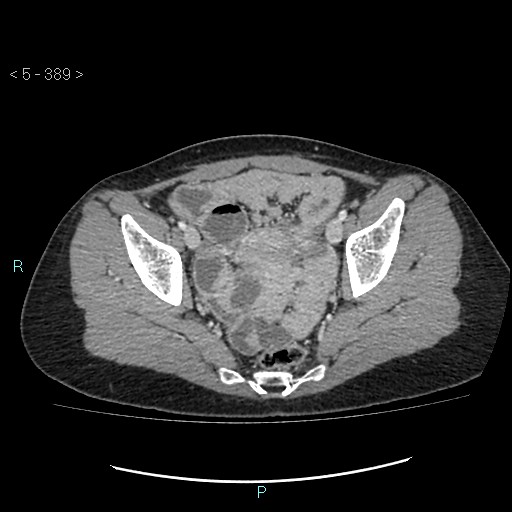 Adult transient intestinal intussusception (Radiopaedia 34853-36310 Axial C+ portal venous phase 100).jpg