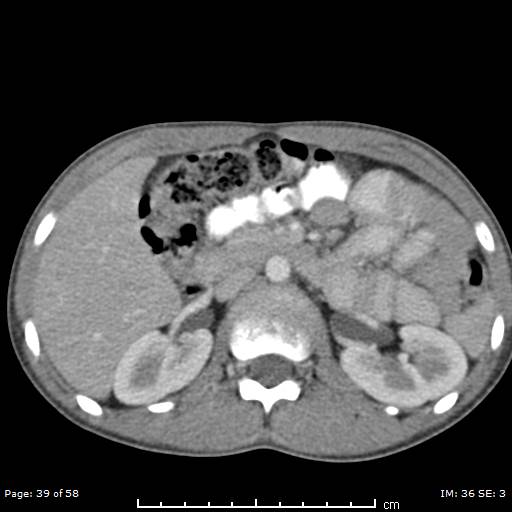 Agenesis of the gallbladder (Radiopaedia 55454-61905 B 39).jpg