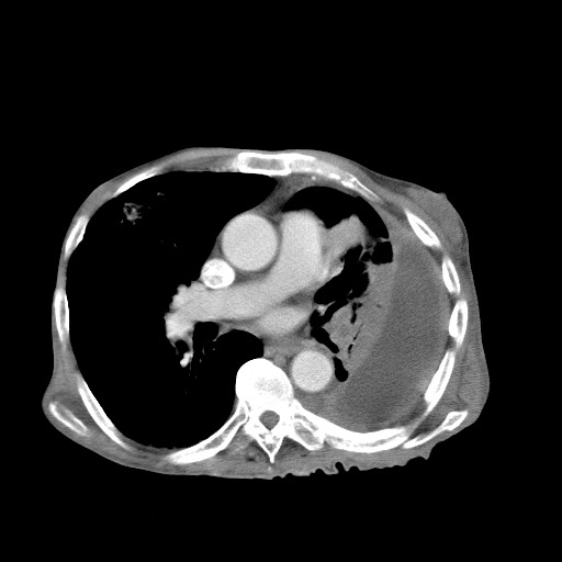 Aggressive lung cancer with cardiac metastases, pulmonary artery tumor thrombus, and Budd-Chiari (Radiopaedia 60320-67981 A 30).jpg