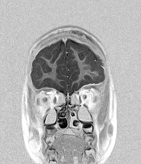 File:Aicardi syndrome (Radiopaedia 66029-75205 Coronal T1-IR 4).jpg
