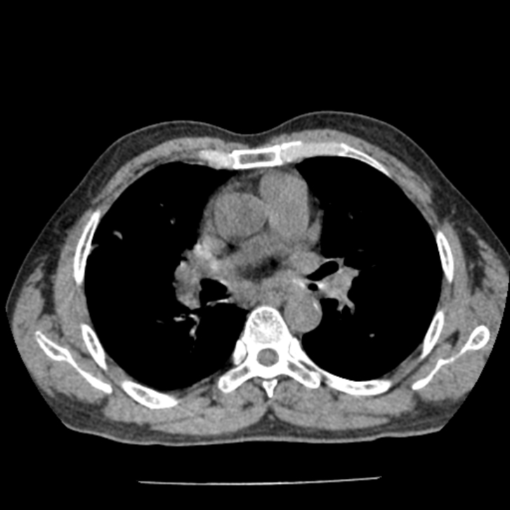 Airway foreign body in adult (Radiopaedia 85907-101779 Axial liver window 77).jpg