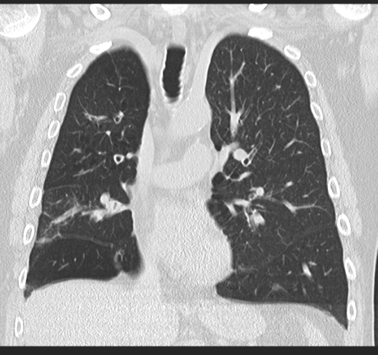 Allergic bronchopulmonary aspergillosis (Radiopaedia 44760-48571 Coronal lung window 28).png