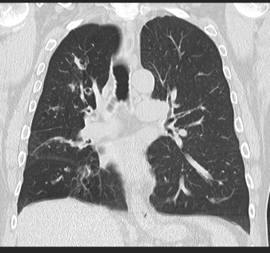 Allergic bronchopulmonary aspergillosis (Radiopaedia 44760-48571 Coronal lung window 31).png