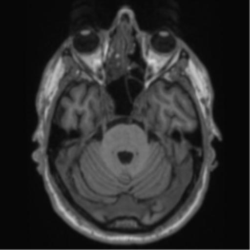 Alzheimer's disease- with Gerstmann syndrome and dressing apraxia (Radiopaedia 54882-61150 Axial T1 21).png