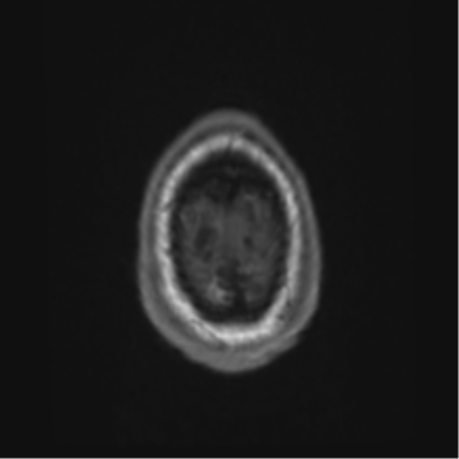 Alzheimer's disease- with Gerstmann syndrome and dressing apraxia (Radiopaedia 54882-61150 Axial T1 73).png