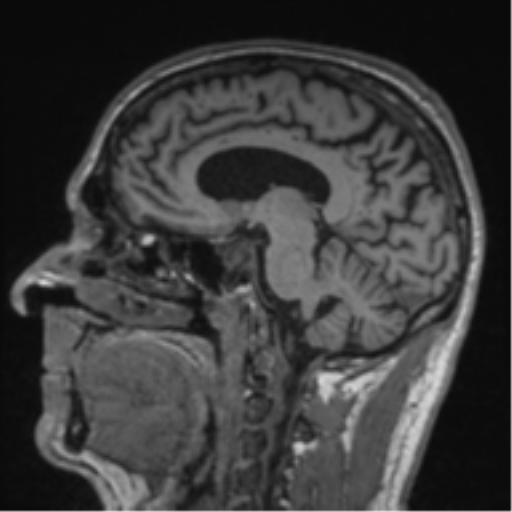 Alzheimer's disease- with Gerstmann syndrome and dressing apraxia (Radiopaedia 54882-61150 Sagittal T1 31).png