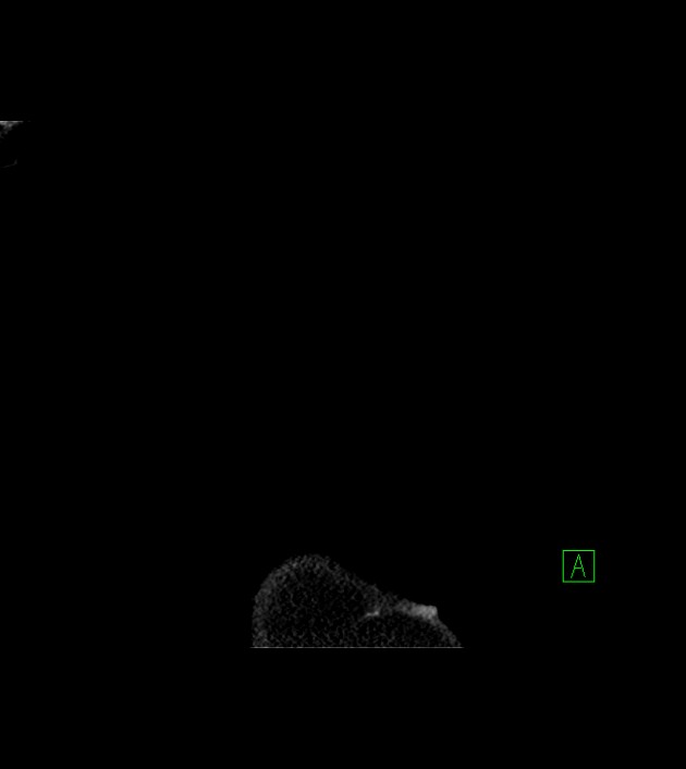 Amiodarone deposition in the liver (Radiopaedia 77587-89780 Coronal non-contrast 2).jpg