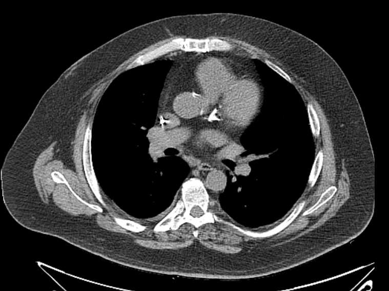 Amiodarone lung (Radiopaedia 62514-70769 Axial non-contrast 43).jpg