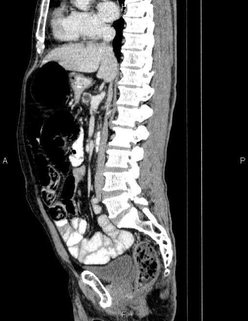Ampullary adenocarcinoma (Radiopaedia 86093-102032 D 45).jpg