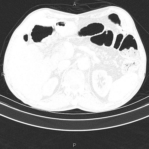 Ampullary adenocarcinoma (Radiopaedia 86093-102033 Axial lung window 58).jpg