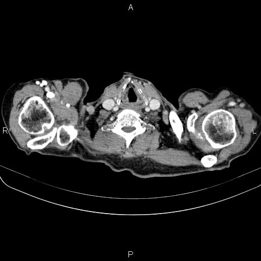 Ampullary adenocarcinoma (Radiopaedia 86093-102033 B 7).jpg
