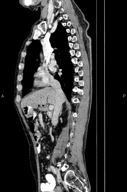 Ampullary adenocarcinoma (Radiopaedia 86093-102033 E 37).jpg