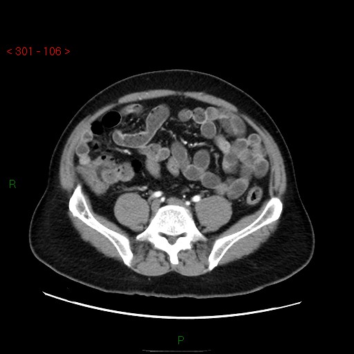 Ampullary carcinoma (Radiopaedia 56396-63056 B 52).jpg