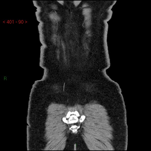 Ampullary carcinoma (Radiopaedia 56396-63056 E 89).jpg