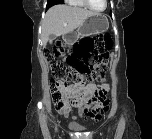 Ampullary tumor (Radiopaedia 60333-67998 B 19).jpg