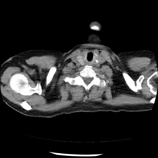 Amyloidosis - bronchial and diffuse nodular pulmonary involvement (Radiopaedia 60156-67744 Axial non-contrast 2).jpg