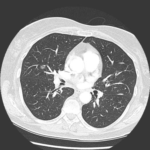 Amyloidosis - bronchial and diffuse nodular pulmonary involvement (Radiopaedia 60156-67745 Axial lung window 40).jpg