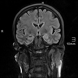 File:Amyotrophic lateral sclerosis (Radiopaedia 70821-81017 Coronal FLAIR 14).jpg